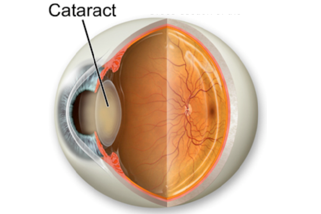 Cataract image