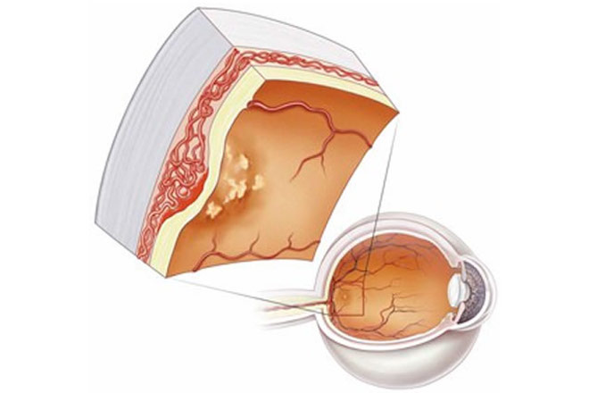 Macular-Degeneration1
