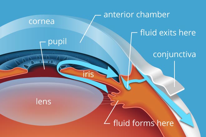 Glaucoma image